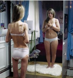 Anorexia – o problema curenta la tinere!