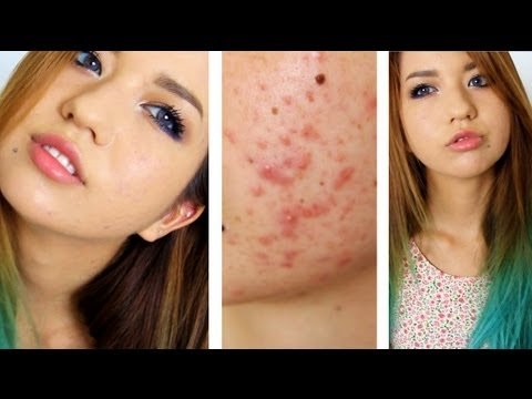 machiaj care acopera acneea