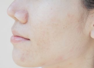 Cum sa contribui la reducerea petelor intunecate de pe piele