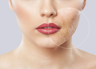 Cele mai bune 9 remedii casnice pentru acnee